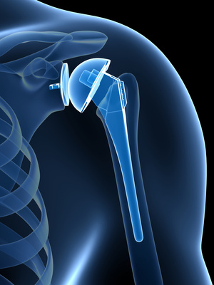 Total shoulder replacement or total shoulder arthroplasty