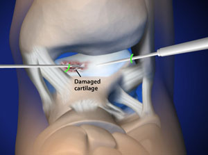 Ankle arthroscopy (minimal invasive surgery) can treat cartilage damage