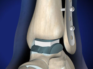 Ankle replacement to treat osteoarthritis of the ankle