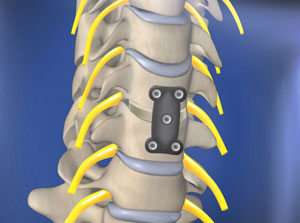 Anterior cervical discectomy and fusion 