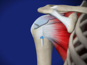 Arthroscopic Rotator Cuff Repair