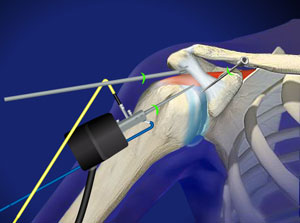 Arthroscopic Rotator Cuff Repair surgery, rotator cuff specialist