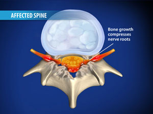 Degenerated Cervical Disc 