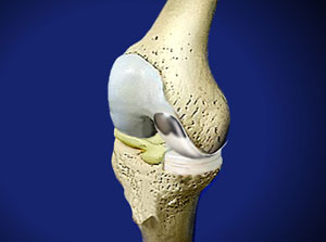 Partial Knee Prosthesis ©Viewmedica Partial Knee Prosthesis