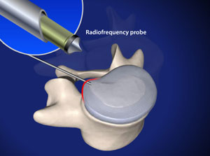 Percutaneous Disc Nucleoplasty 