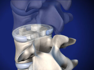 Posterior Lumbar Interbody Fusoin (PLIF) 