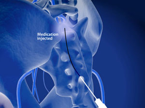 Инъекционное лечение хронических болей в спине и седалищной боли в Германии 