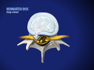 Degenerated Cervical Disc 