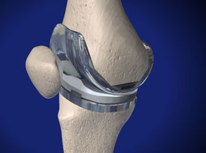 Knee specialist approach to total knee replacement