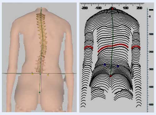 3D spine measurement