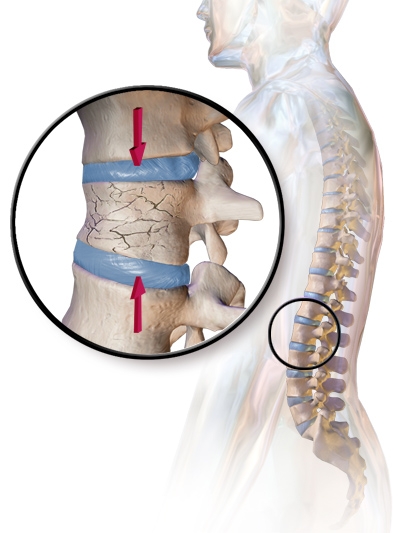 Остеопоротический перелом позвоночного столба: Кифопластика способствует восстановлению перелома тел позвонков.