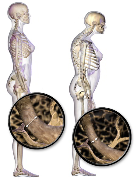 Cyphoplastie : Réparation de fractures vertébrales par compression ...