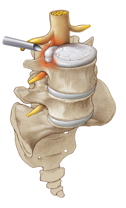 Une hernie discale peut être identifié et éliminé par un dispositif tubulaire sans chirurgie dos ouvert