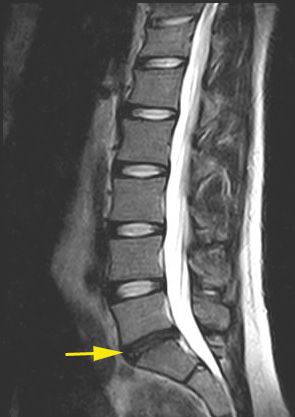 Degenerated disc with lower fluid content.