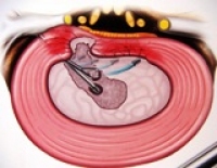 Treating the bulging disc with the Disc-FX system. Bulging discs are caused by the liquid nucleus pulposus shifting inside the disc. The fibrous ring of the disc is deformed, but not yet ruptured