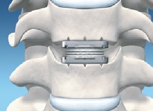 Cervical disc prosthesis M6-C