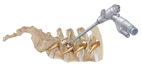 La chirurgie endoscopique de la colonne vertébrale utilise les voies d’accès à la colonne vertébrale existantes afin d’éviter tout traumatisme sur les os et les muscles.