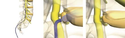 Racz epidural infiltration