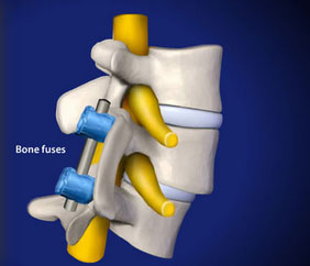 spondylodesis: spinal fusion