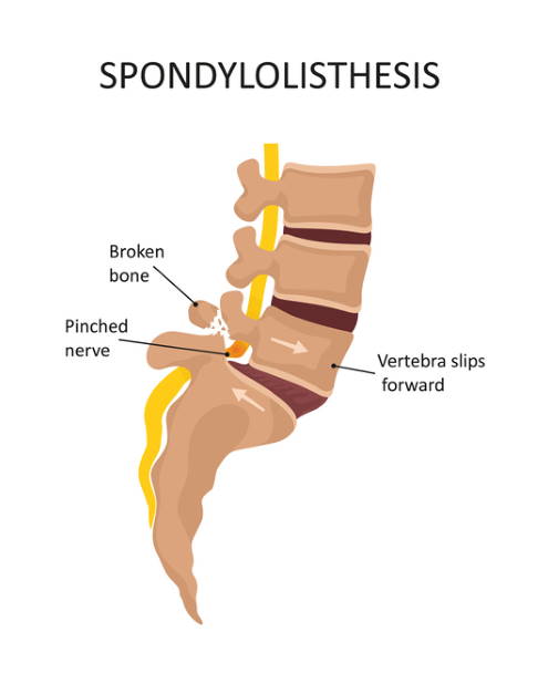 Desteklemek ana tempo  Vertebral Fusion Surgery (Spondylodesis) as therapy for Spondylolisthesis  (instability of vertebral spine) | Joint-surgeon.com