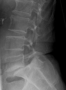 X-ray image of a severe L5/S1 spondylolisthesis