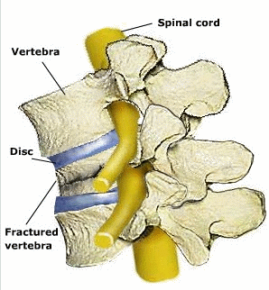Kyphoplasty: Step 1: Tube is inserted. Step 2: Balloon is inserted and inflated. Step 3: Bone cement or silicone material is inserted into the fractured vertebral bone© via4spine Kyphoplasty: Step 1: Tube is inserted. Step 2: balloon is inserted and inflated. Step 3: Bone cement or silicone material is inserted into the fractured vertebral bone